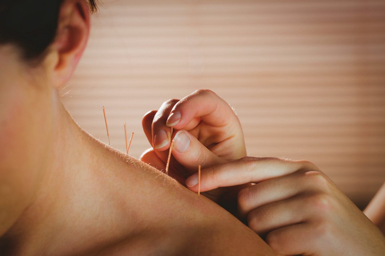 https://myspinewellness.com/wp-content/uploads/2018/11/dry-needling.jpg