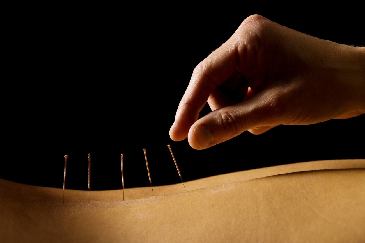 Spine Wellness Center Dry Needling